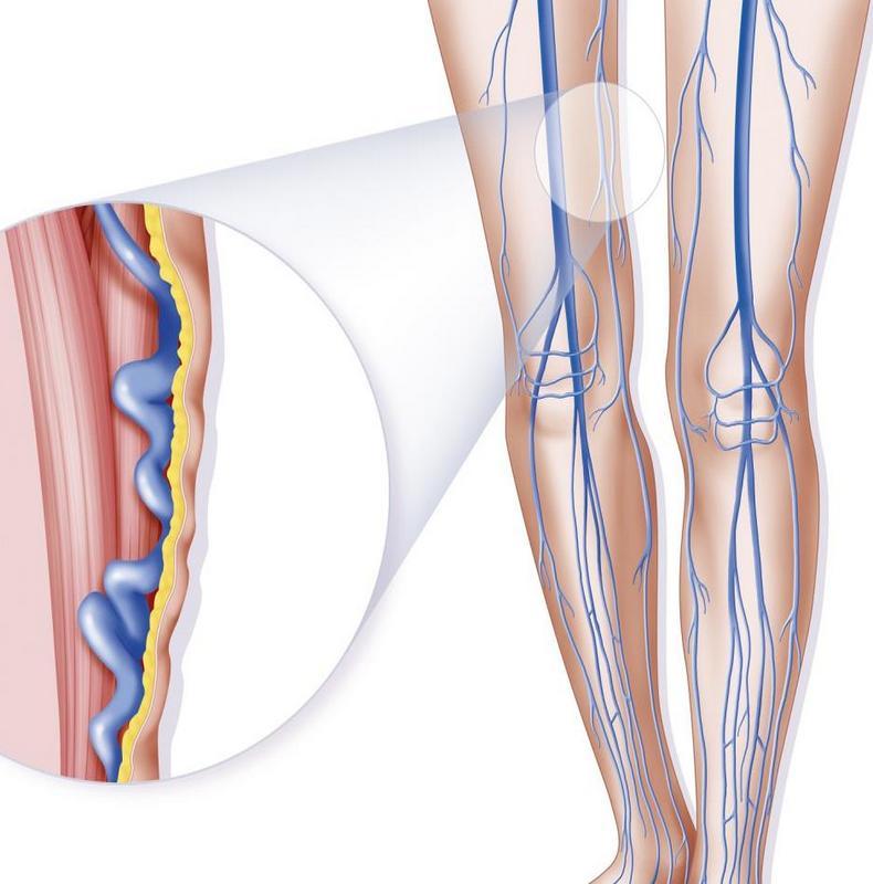 Варикоз Вен Нижних Конечностей