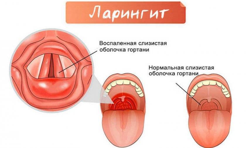 Ангина рисунок для детей