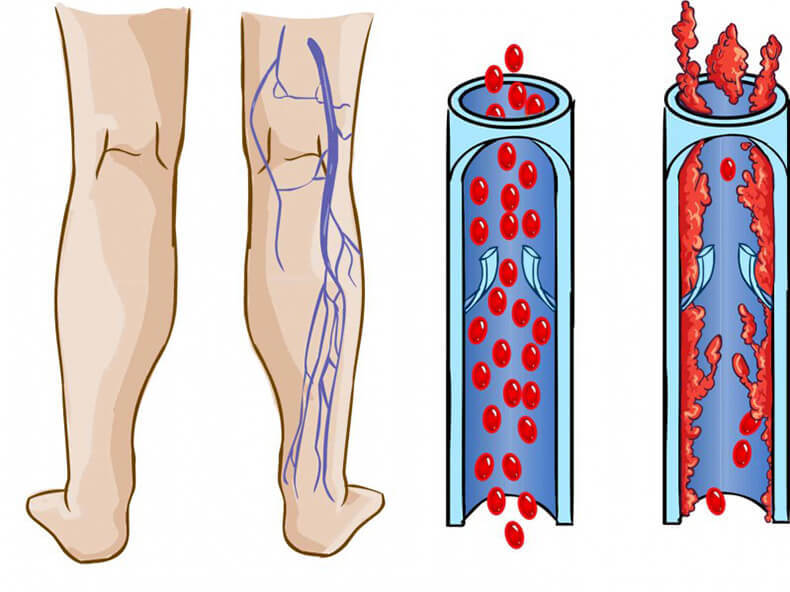 Варикоз Вен Из-За Чего