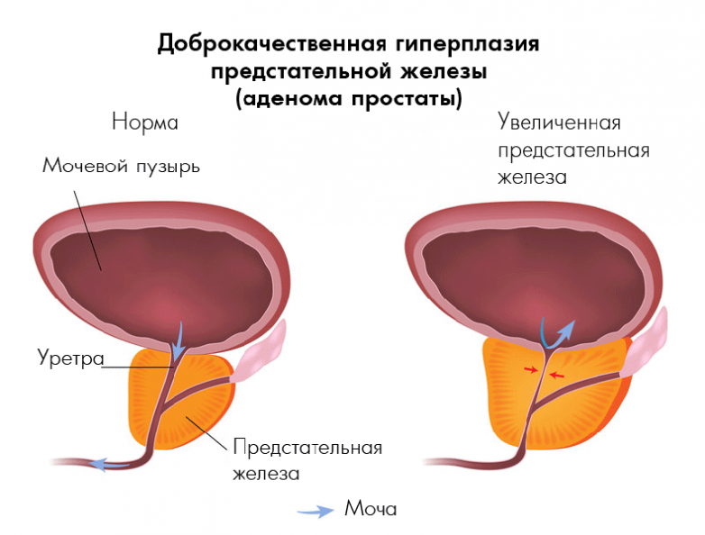 Упражнения при аденоме простаты