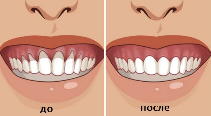 Вы заметили оголение шейки или корня зуба? Немедленно начинайте лечение — 6 натуральных рецептов!