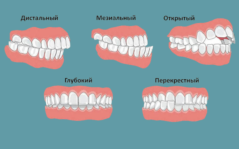 Правильный прикус у человека фото схема