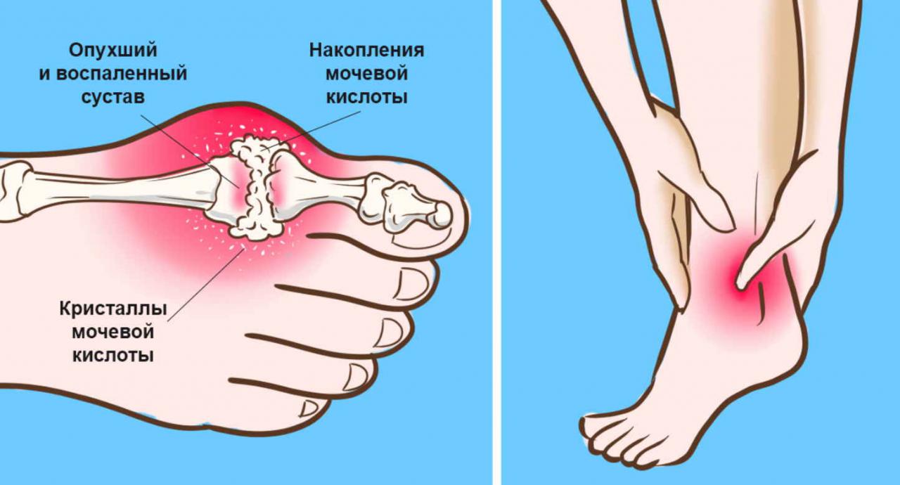 Мочевая кислота подагра