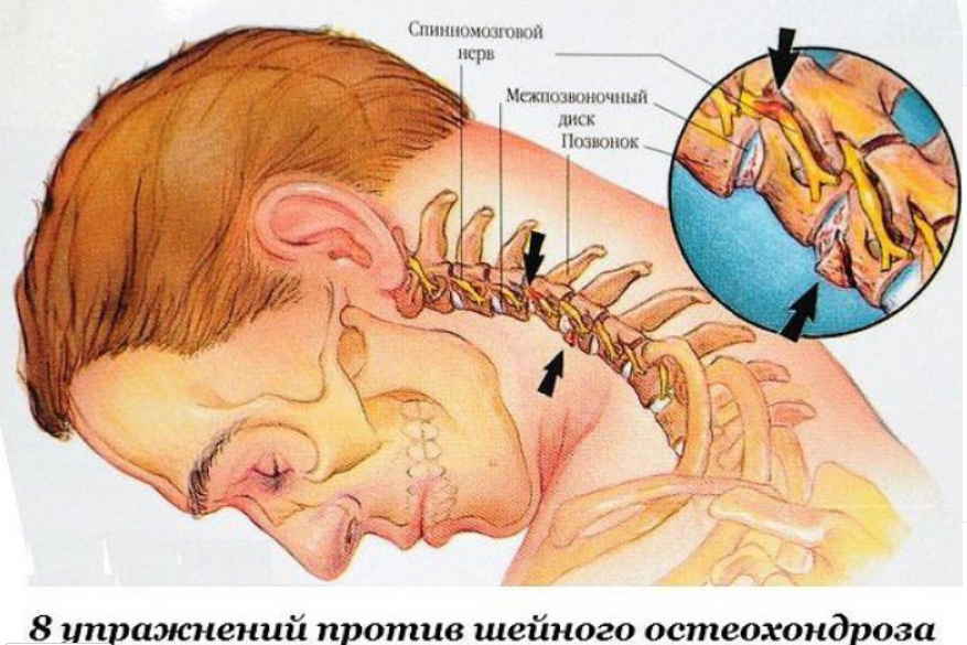 Восемь упражнений против шейного остеохондроза