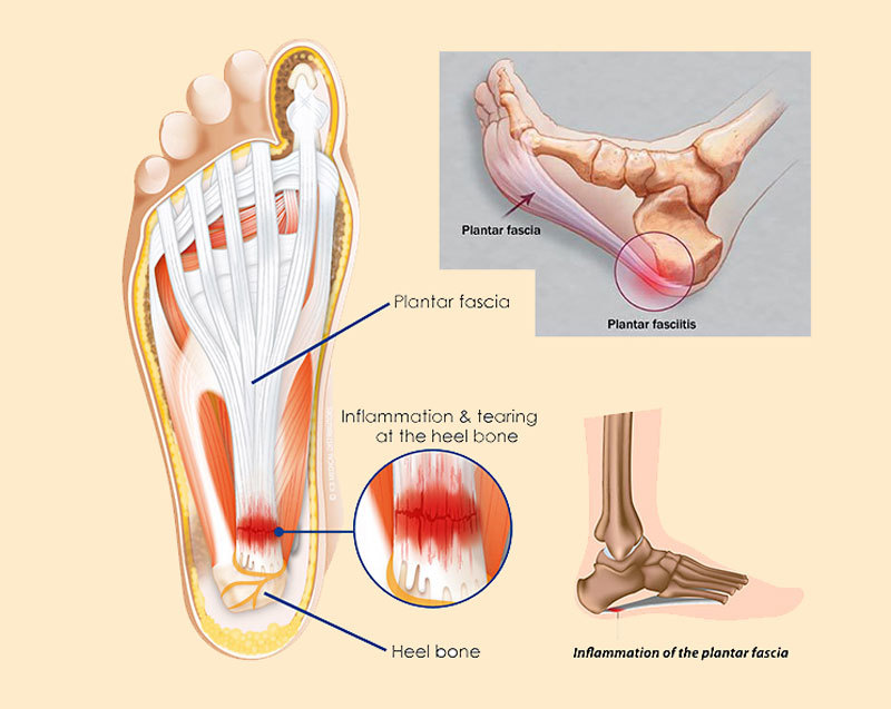 Подошвенный фасциит что это такое фото