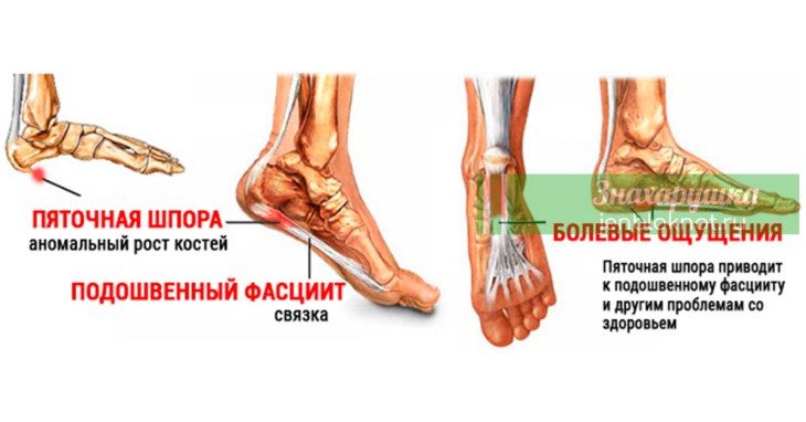 Сейчас Вы Узнаете Как избавиться от Пяточной Шпоры